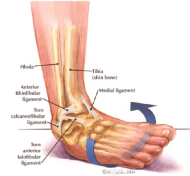 Ankle Sprain physio