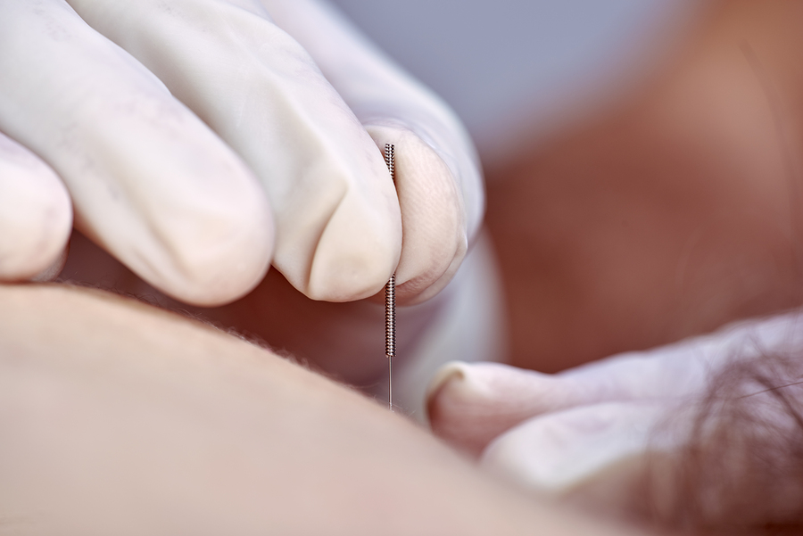  Physiotherapist performs dry needling